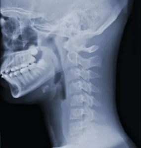 RX CUELLO LATERAL (PARTES BLANDAS)