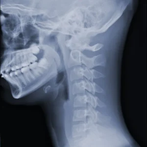 RX CUELLO LATERAL (PARTES BLANDAS)