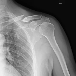 RX HOMBRO DOS PROYECCIONES