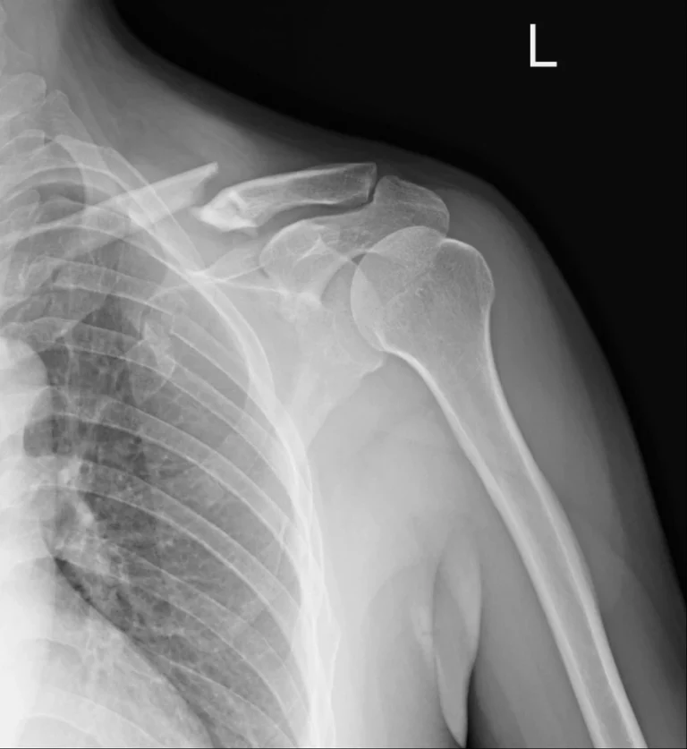 RX HOMBRO DOS PROYECCIONES