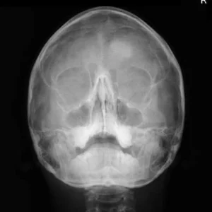 RX PERFILOGRAMA DOS PROYECCIONES (NARIZ) + WATERS