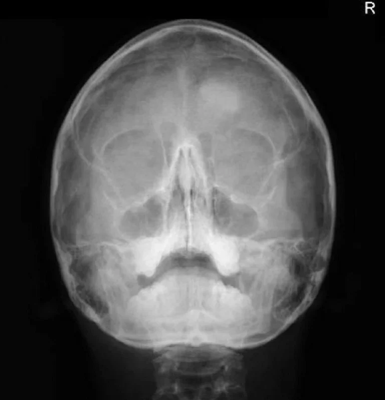 RX PERFILOGRAMA DOS PROYECCIONES (NARIZ) + WATERS