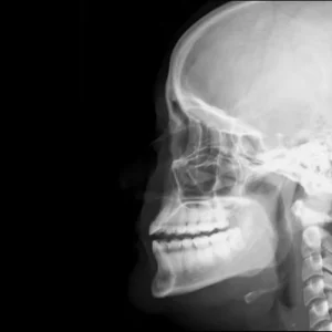 RX PERFILOGRAMA UNA PROYECCIÓN (NARIZ)