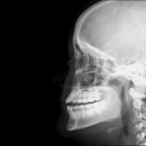 RX PERFILOGRAMA UNA PROYECCIÓN (NARIZ)