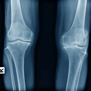 RX RODILLAS PERFIL TRES PROYECCIONES
