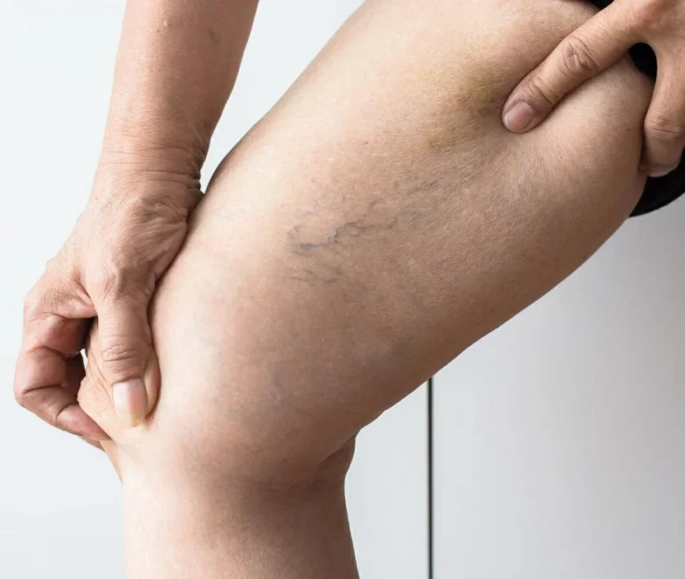 PERFIL DE TROMBOFILIA COMPLETO